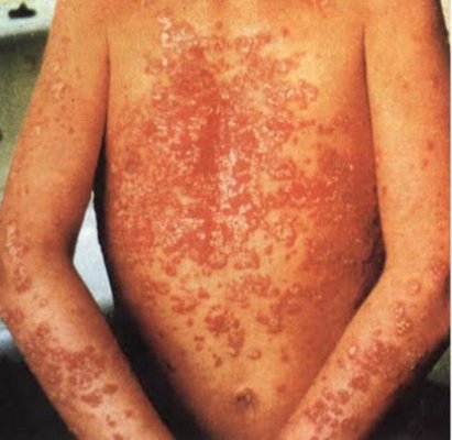 Bilanţ dureros: aproximativ 400.000 de români suferă de psoriazis